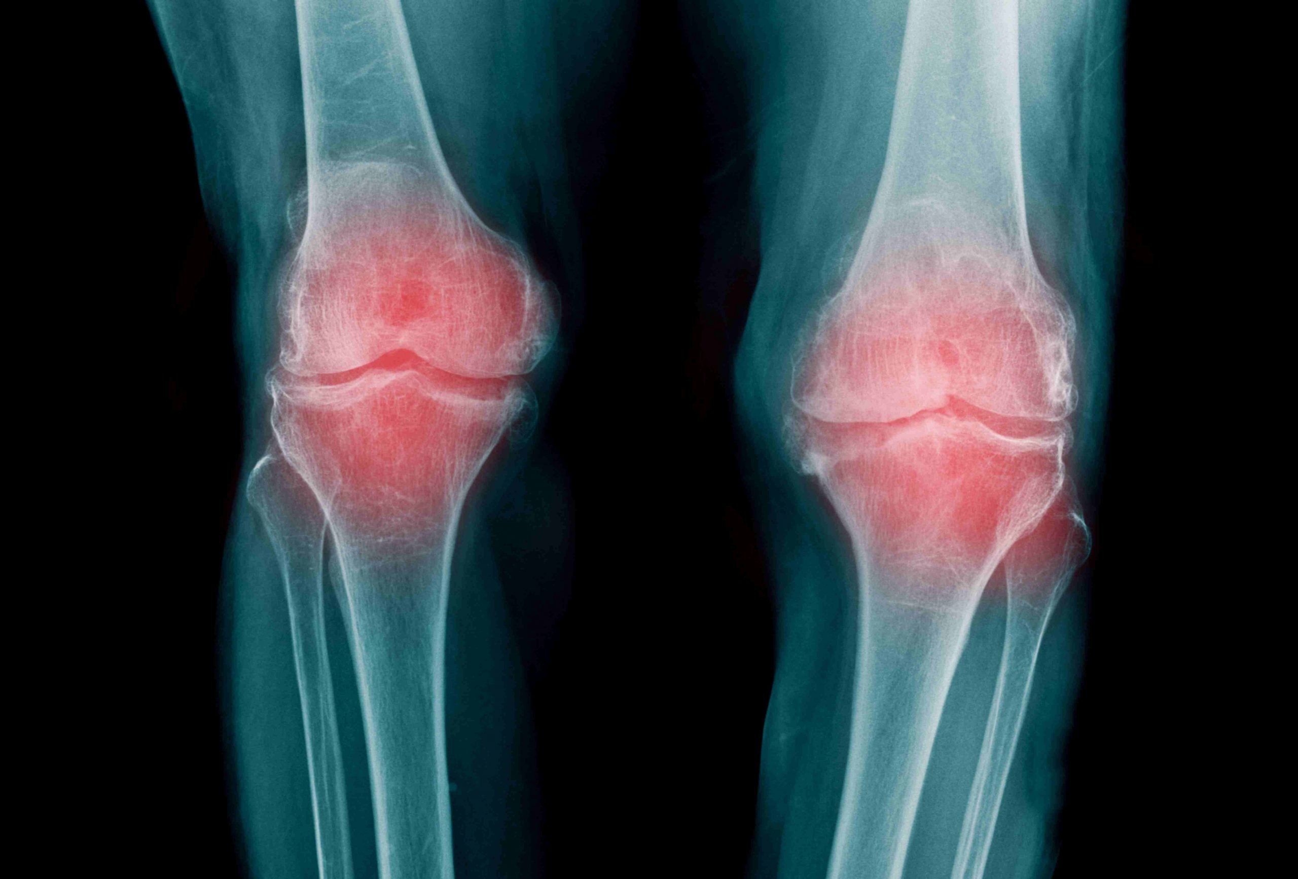 découvrez les croyances sur l'arthrose du genou avec Uperform